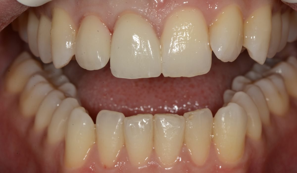 Deux couronnes incisives sur les dents 11 et 12 en e.max pressé et stratifié, réalisées par le laboratoire K-DENT.
